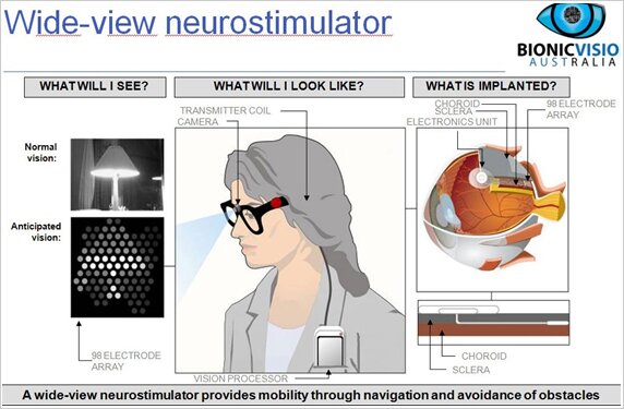 wide-view neurostimulator
